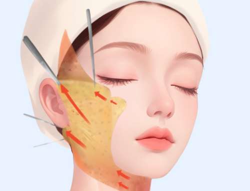 小拉皮術后7天恢復情況如何？腫成 “發面饅頭” 到驚艷蛻變